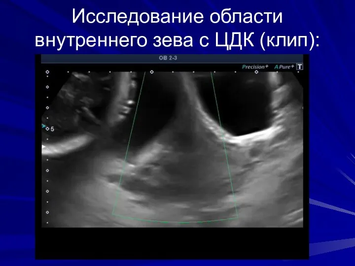 Исследование области внутреннего зева с ЦДК (клип):