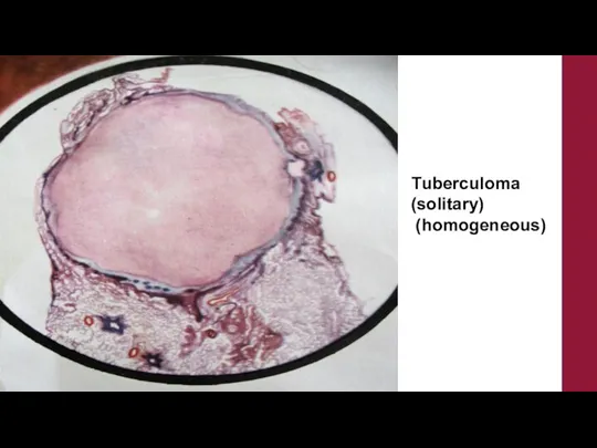 Тuberculoma (solitary) (homogeneous)