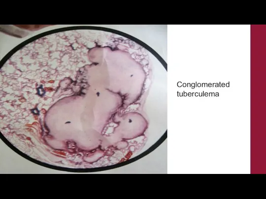 Conglomerated tuberculema