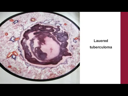 Lauered tuberculoma
