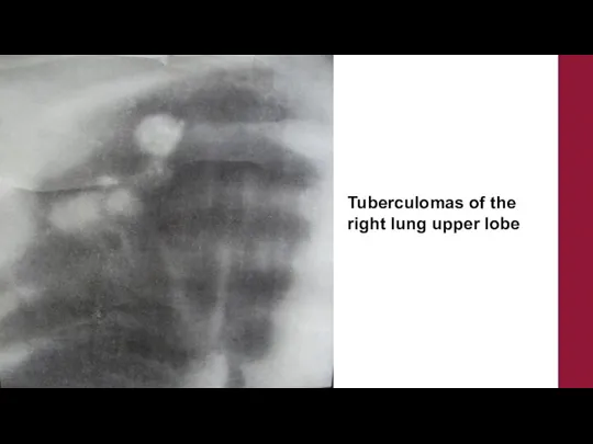 Tuberculomas of the right lung upper lobe