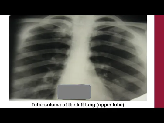 Tuberculoma of the left lung (upper lobe)