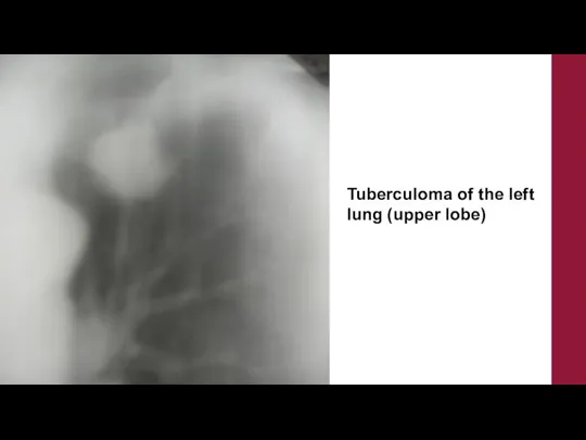 Tuberculoma of the left lung (upper lobe)