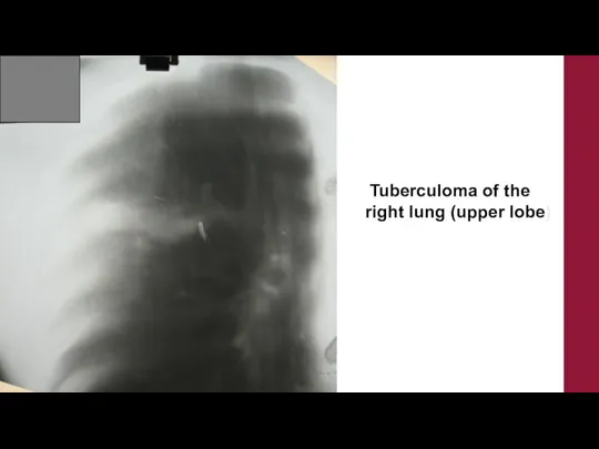 Tuberculoma of the right lung (upper lobe)