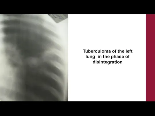 Tuberculoma of the left lung in the phase of disintegration