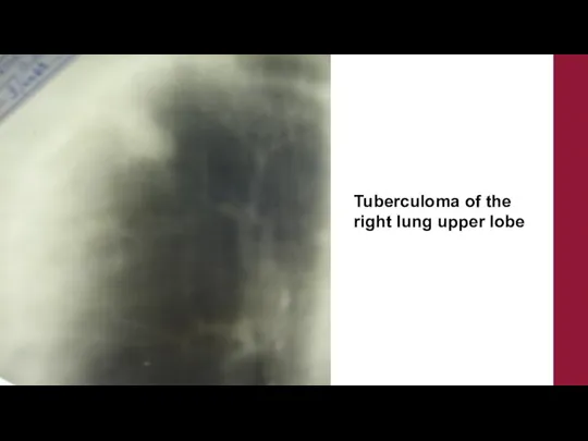 Tuberculoma of the right lung upper lobe