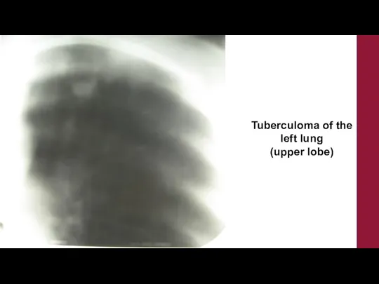 Tuberculoma of the left lung (upper lobe)