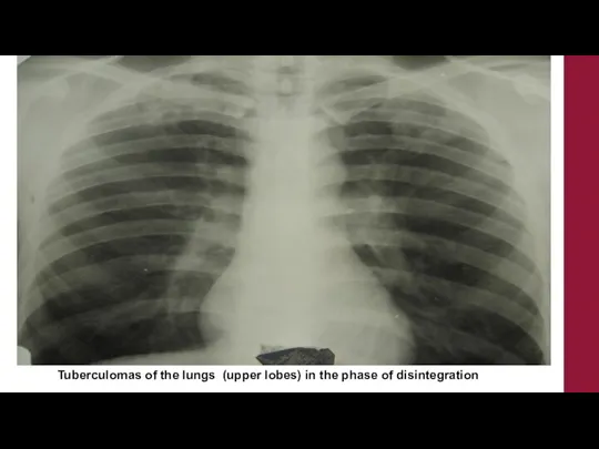 Tuberculomas of the lungs (upper lobes) in the phase of disintegration