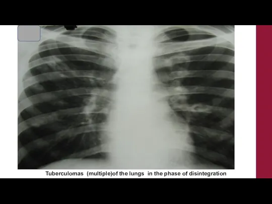 Tuberculomas (multiple)of the lungs in the phase of disintegration