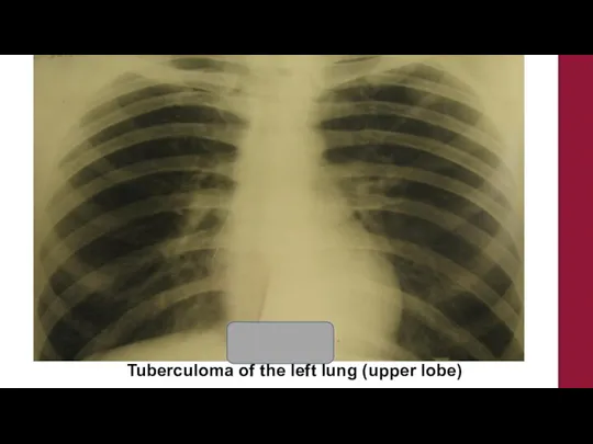 Tuberculoma of the left lung (upper lobe)