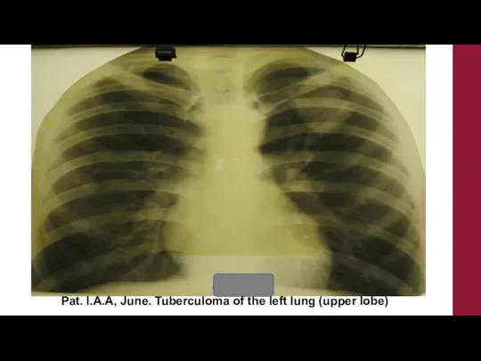 Pat. I.A.A, June. Tuberculoma of the left lung (upper lobe)