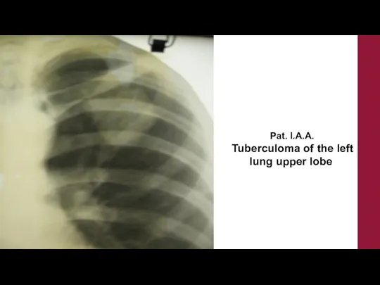 Pat. I.A.A. Tuberculoma of thе left lung upper lobe