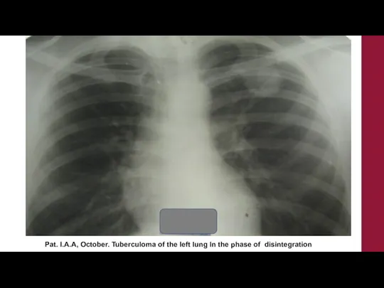 Pat. I.A.A, October. Tuberculoma of the left lung In the phase of disintegration