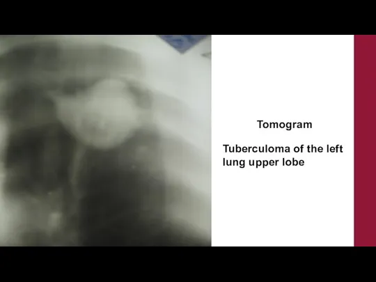 Tomogram Tuberculoma of the left lung upper lobe