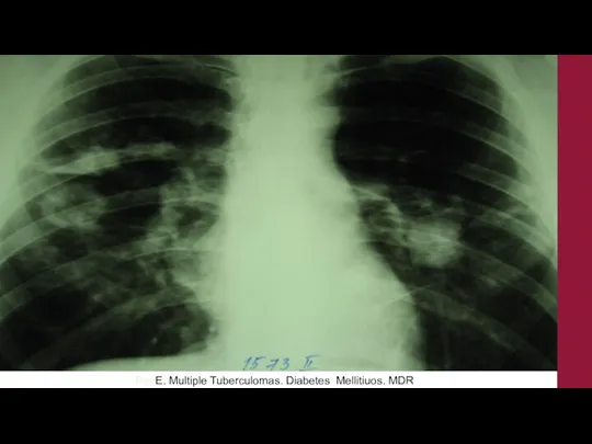 Pat E. Мultiple Tuberculomas. Diabetes Mellitiuos. MDR