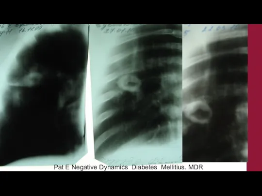 Pat E Negative Dynamics Diabetes Mellitius. MDR