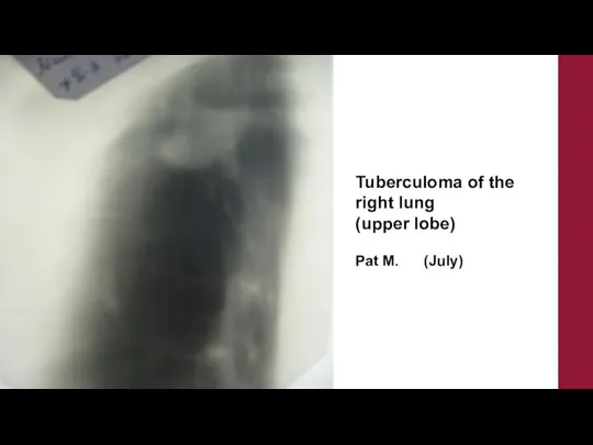 Tuberculoma of the right lung (upper lobe) Pat M. (July)