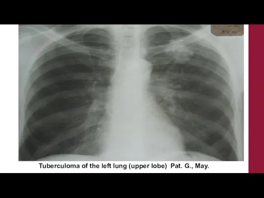 Tuberculoma of the left lung (upper lobe) Pat. G., May.