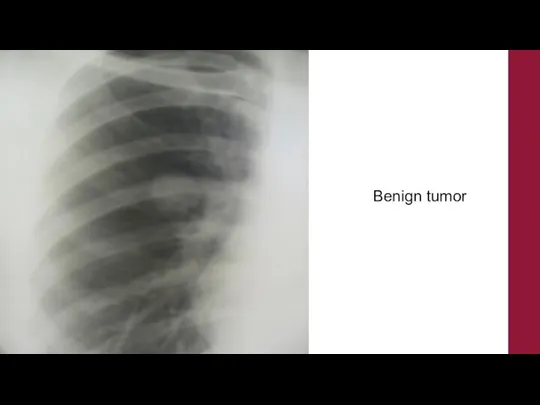 Benign tumor