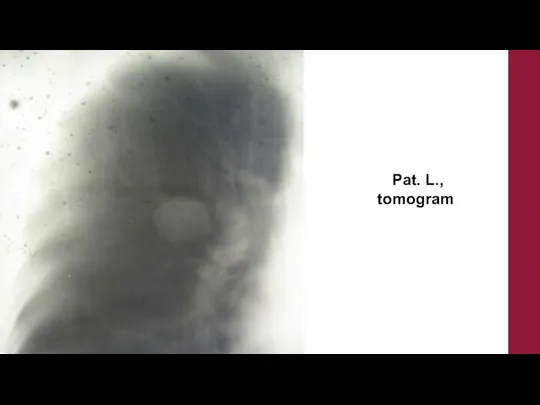 Pat. L., tomogram