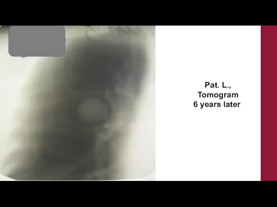 Pat. L., Tomogram 6 years later