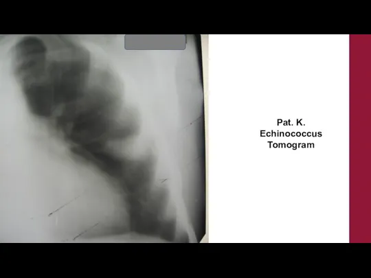 Pat. K. Echinococcus Tomogram