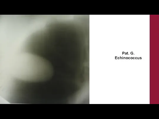 Pat. G. Echinococcus