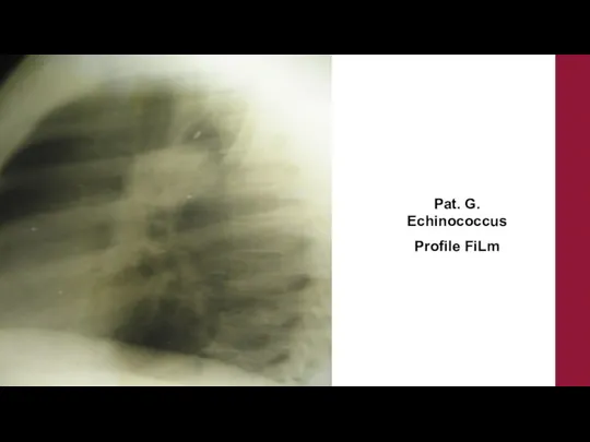 Pat. G. Echinococcus Profile FiLm