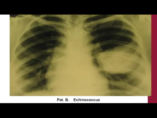 Pat. B. Echinococcus