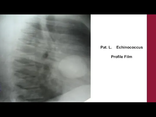 Pat. L. Echinococcus Profile Film