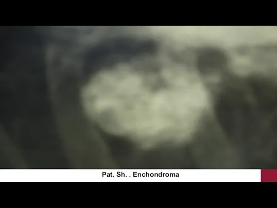 Pat. Sh. . Enchondroma