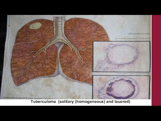 Тuberculoma (solitary (homogeneous) and lauered)