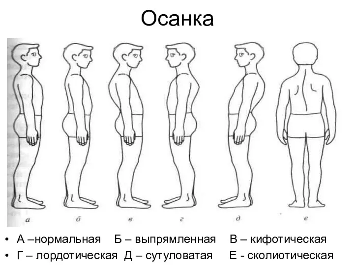 Осанка А –нормальная Б – выпрямленная В – кифотическая Г – лордотическая