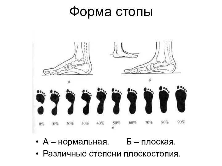 Форма стопы А – нормальная. Б – плоская. Различные степени плоскостопия.