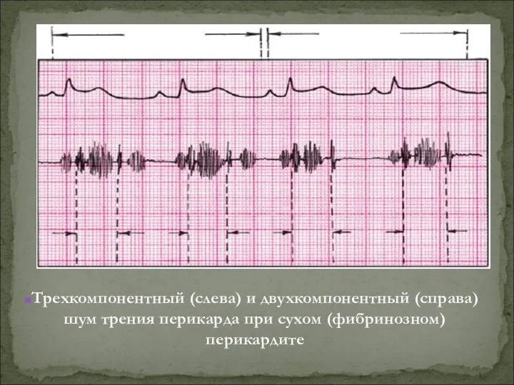 Трехкомпонентный (слева) и двухкомпонентный (справа) шум трения перикарда при сухом (фибринозном) перикардите