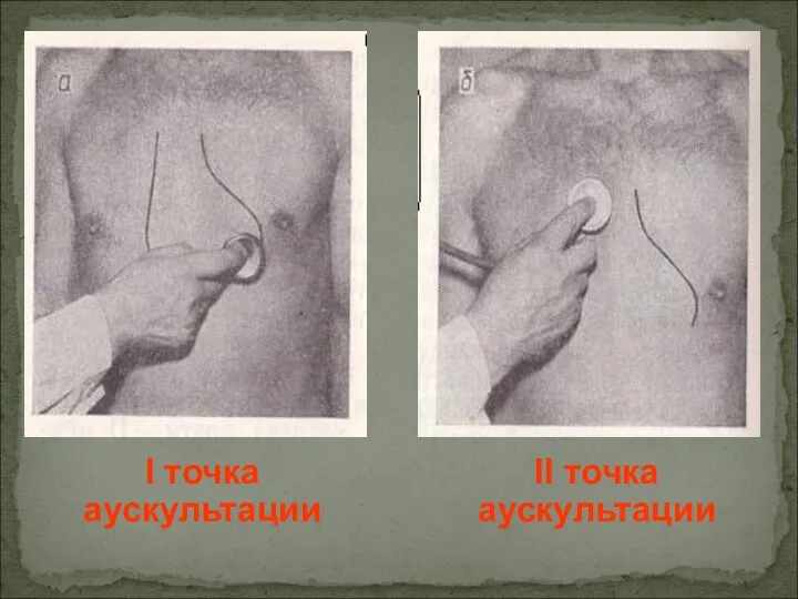 I точка аускультации II точка аускультации