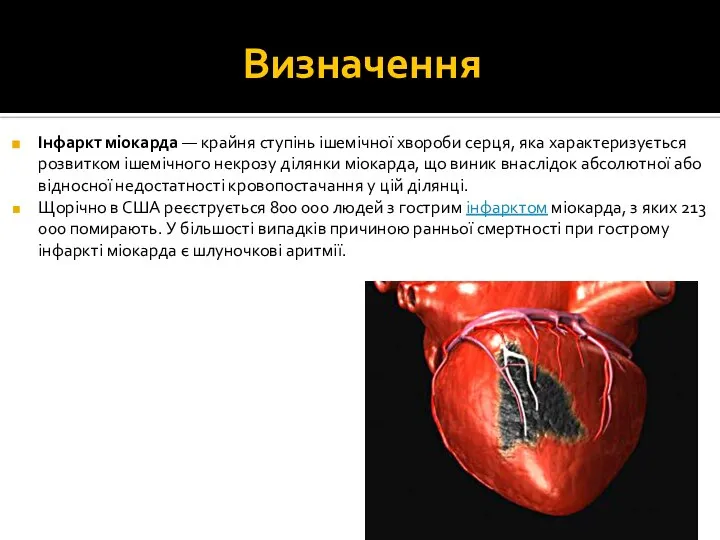 Визначення Інфаркт міокарда — крайня ступінь ішемічної хвороби серця, яка характеризується розвитком