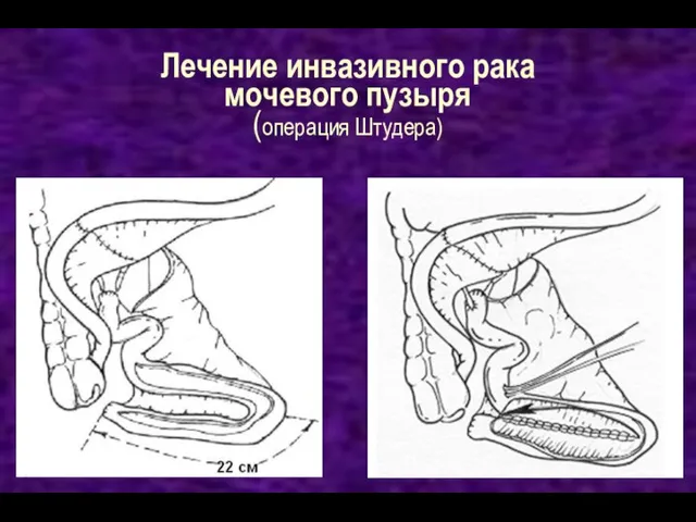 Лечение инвазивного рака мочевого пузыря (операция Штудера)