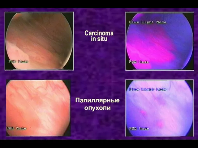 Carcinoma in situ Папиллярные опухоли