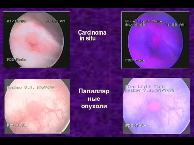 Carcinoma in situ Папиллярные опухоли