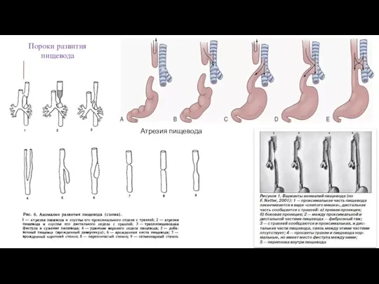Пороки развития пищевода Атрезия пищевода