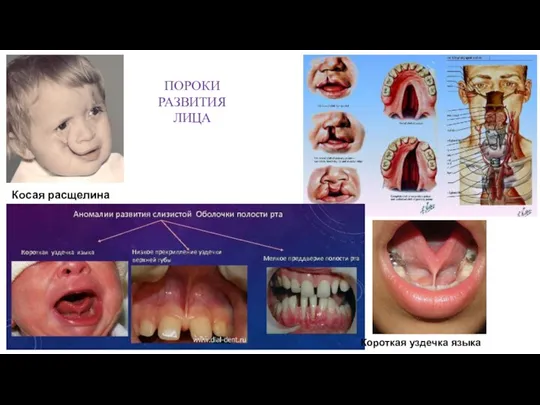 ПОРОКИ РАЗВИТИЯ ЛИЦА Косая расщелина лица Короткая уздечка языка