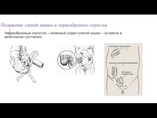 Положение слепой кишки и червеобразного отростка Червеобразный отросток – конечный отдел слепой