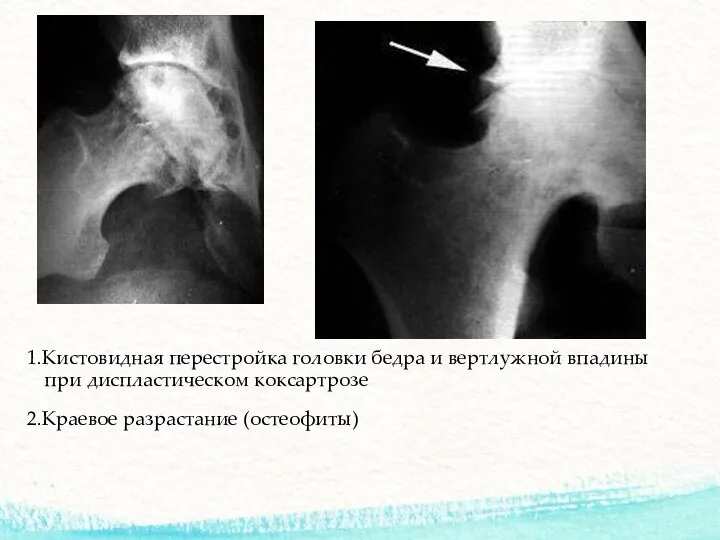 1.Кистовидная перестройка головки бедра и вертлужной впадины при диспластическом коксартрозе 2.Краевое разрастание (остеофиты)