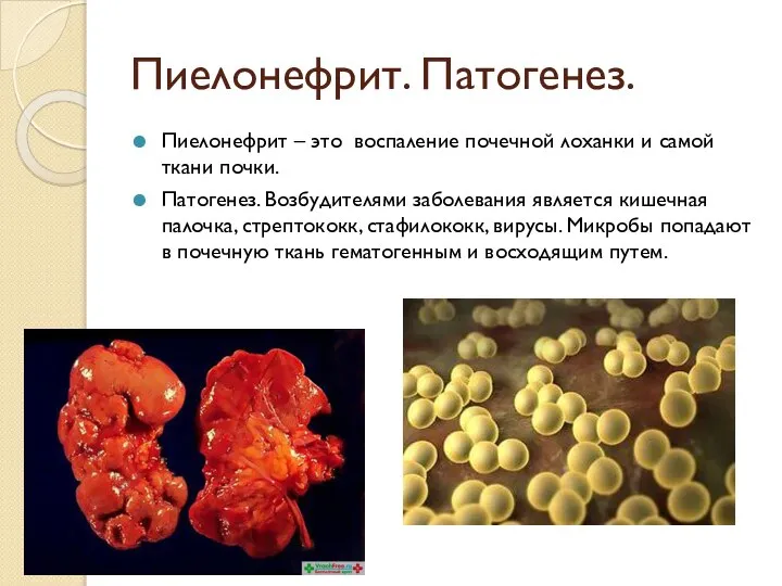 Пиелонефрит. Патогенез. Пиелонефрит – это воспаление почечной лоханки и самой ткани почки.