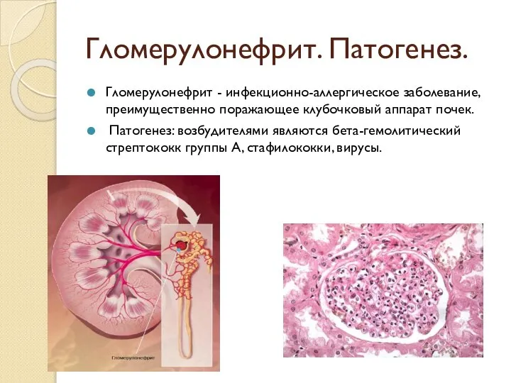 Гломерулонефрит. Патогенез. Гломерулонефрит - инфекционно-аллергическое заболевание, преимущественно поражающее клубочковый аппарат почек. Патогенез: