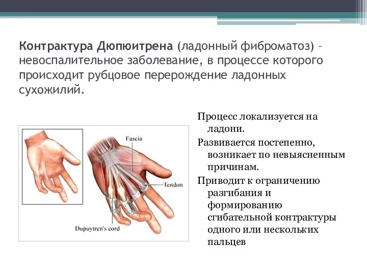 Контрактура Дюпюитрена (ладонный фиброматоз) – невоспалительное заболевание, в процессе которого происходит рубцовое