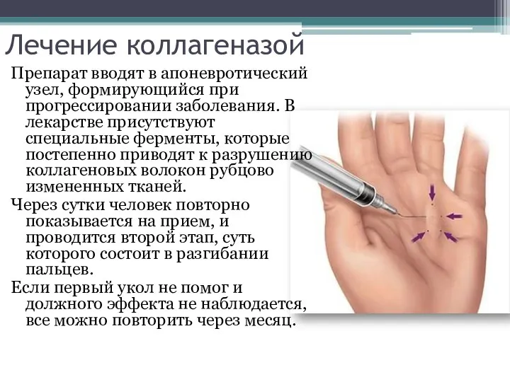 Лечение коллагеназой Препарат вводят в апоневротический узел, формирующийся при прогрессировании заболевания. В