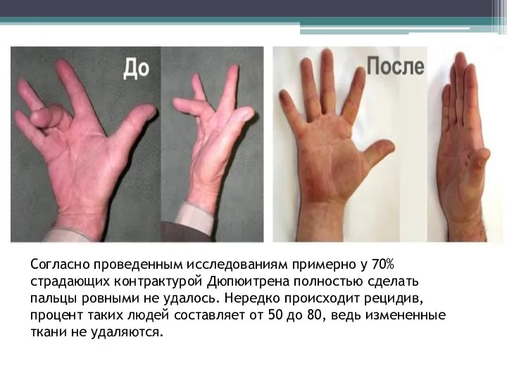 Согласно проведенным исследованиям примерно у 70% страдающих контрактурой Дюпюитрена полностью сделать пальцы