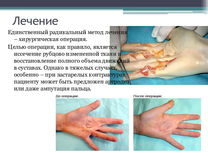Лечение Единственный радикальный метод лечения – хирургическая операция. Целью операции, как правило,